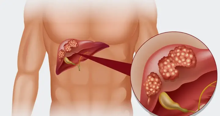 中国肝癌研究新突破：调节肠道菌群或是保护肝功能的关键