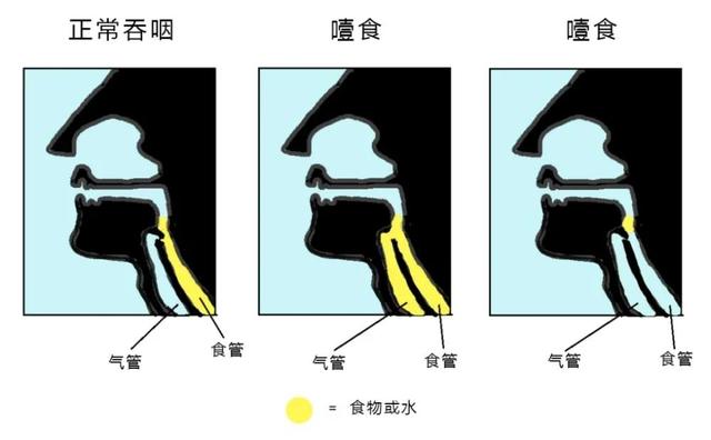 喝水呛咳怎么办？