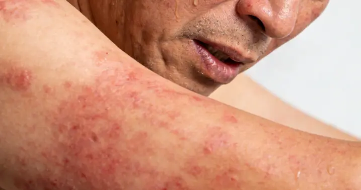 湿疹反复不愈者警惕！中医祛湿疏风法，辨证调理止痒固肤不反复