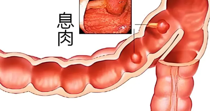 提醒：肠道开始有息肉的第一信号，喝水就知？很多人都没放心上