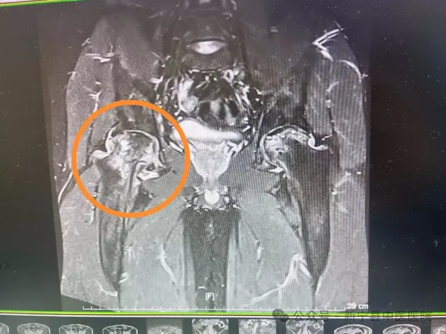 36岁男子股骨头坏死！他们成功行髋关节置换术让他脱拐行走