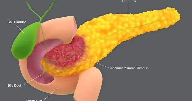 警惕“癌王”胰腺癌！3类食物是“元凶”，管住嘴+做好2件事