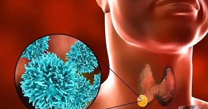 25岁！甲状腺切除，4年后肺转移？主任：优甲乐别乱吃！