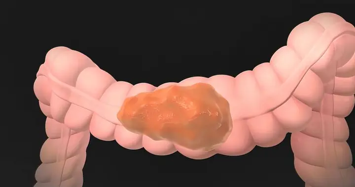 2种肠息肉，几乎100%变成癌！上厕所或5个提示，别等到肠癌才后悔