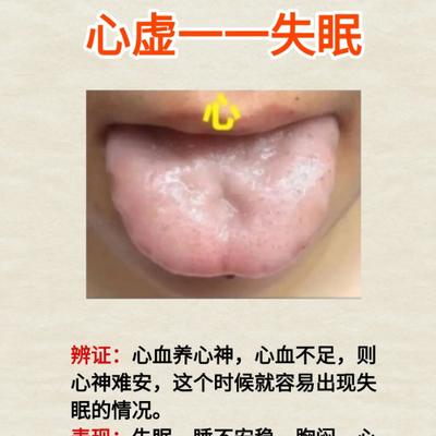 正能量的刘医生：五脏虚了有信号！5 种舌