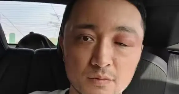 尼格买提冲上热搜！一只眼睛红肿严重，原因曝光后，让人哭笑不得