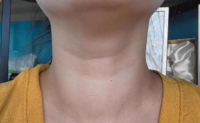 气出来的结节，打开身上的2个出气筒，让结节自己消失