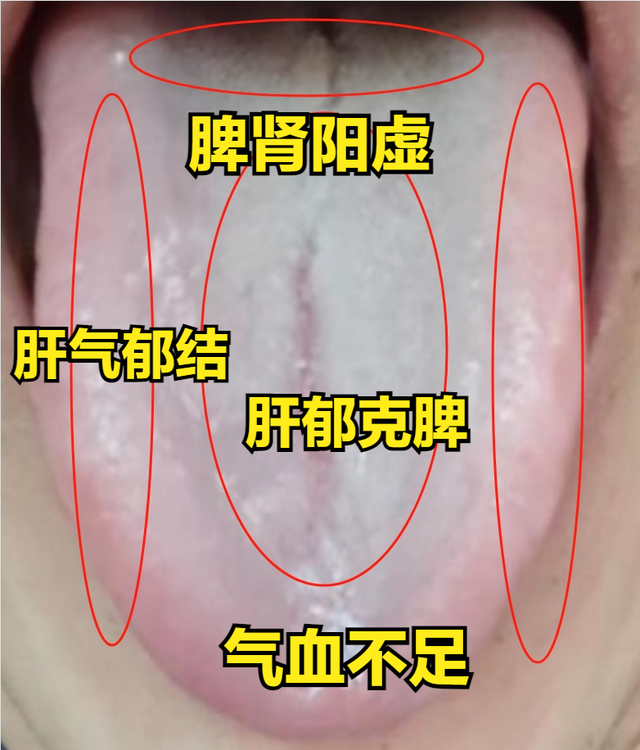 这样舌象的气血不足、气血两虚，别再补了，否则会越补越虚！