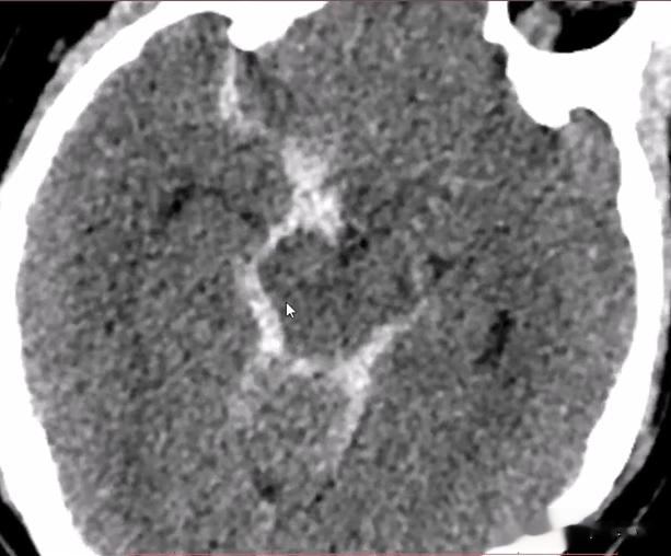 动脉瘤|48岁女性，外伤后头痛剧烈，头颅CT发现了什么危急重症？