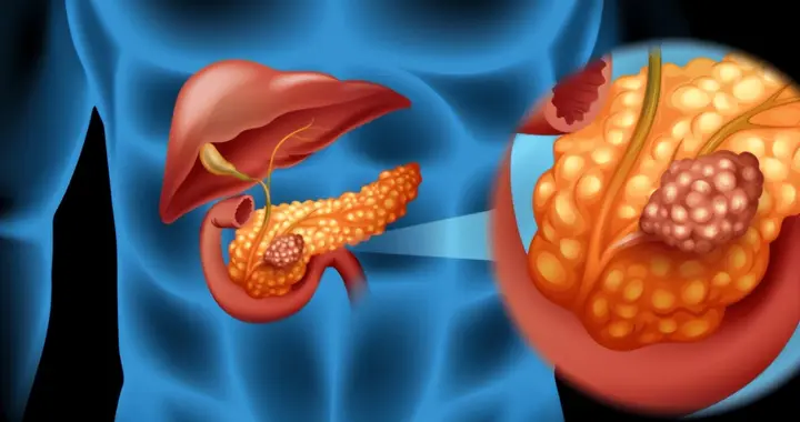 全球四分之一胰腺癌在我国，提醒：不想胰腺受伤，6种零食要少吃