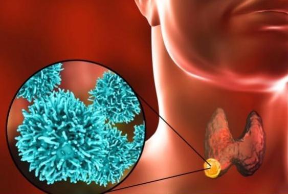 痰湿瘀血越多，囊肿结节长的越快，老中医教你改变痰瘀体质