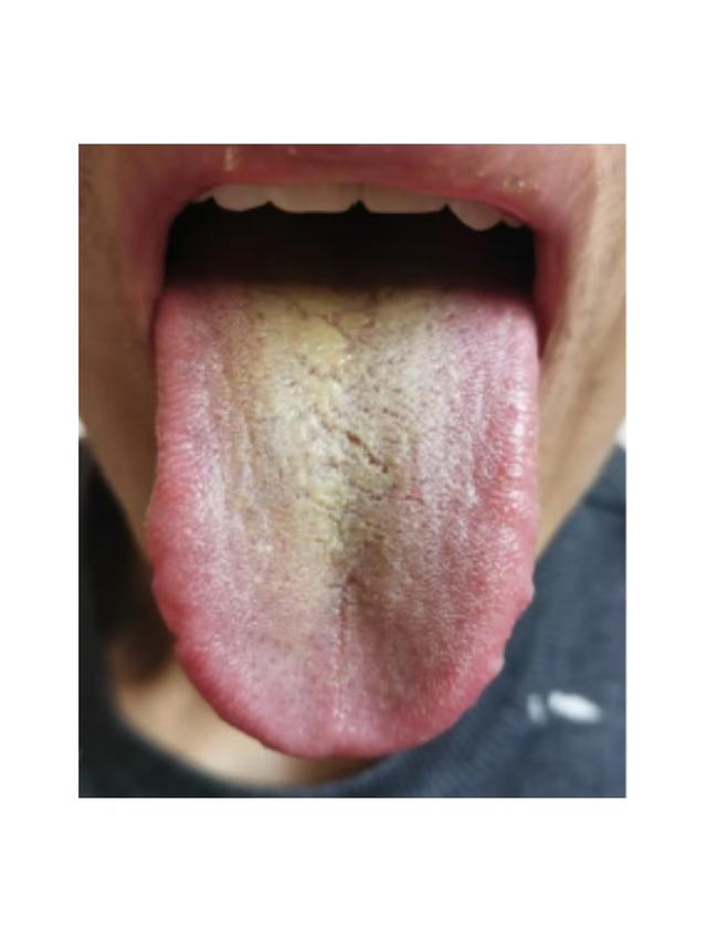 舌苔黄腻，清热燥湿却频频上火？关键在于忽视了阴虚的问题！