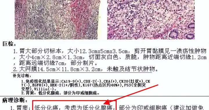 80%复发转移患者属浸润癌，若同时出现这3点，务必高度重视！