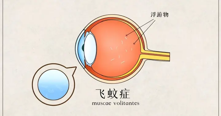 飞蚊散去，视界清晰——干细胞助您回归无影世界！