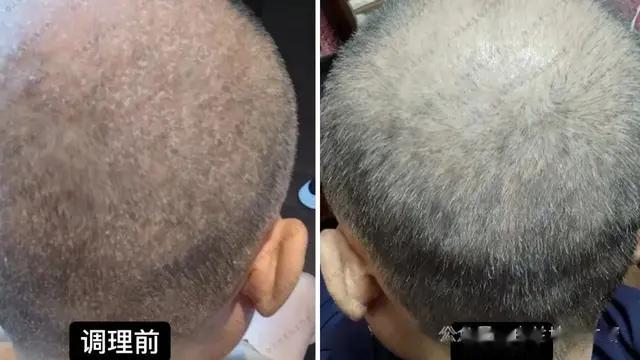 头皮银屑病，坚持洗，一天比一天好