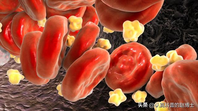生酮饮食→胆固醇升高，需要小心吗？最新研究：这类人斑块不进展