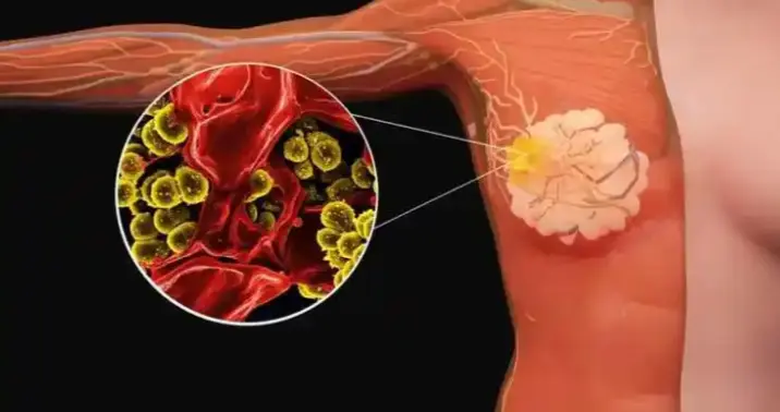 LuminalA和LuminalB分型的乳腺癌，哪种好治？