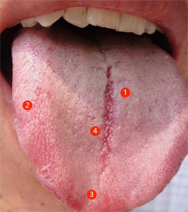 何大夫实战舌诊分析：看似普通的舌头，但是隐藏着很多病情！