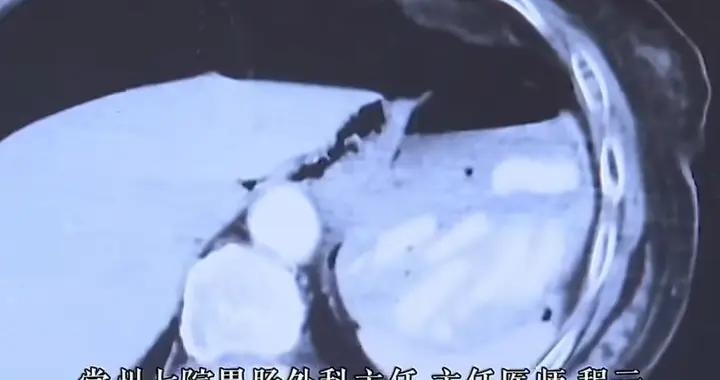 老人吃年糕噎住，家人急救却压破胃！用错误方法可“催命”