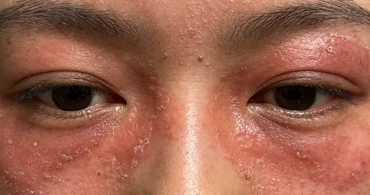 医生：红斑狼疮易被忽视！发病较隐匿 可进行抗核抗体检查