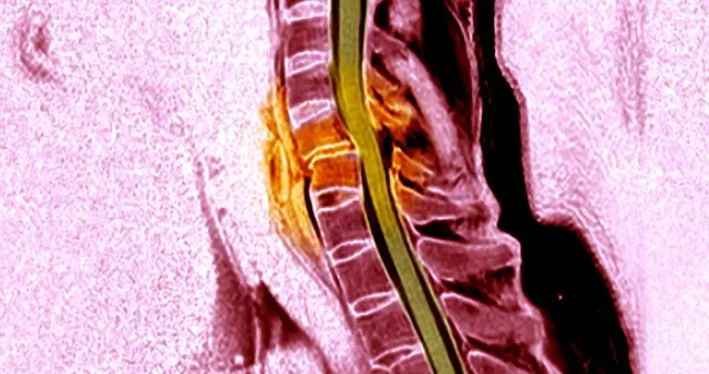 脊髓型颈椎病完全恢复，难度究竟几何？