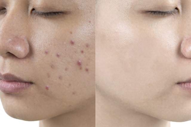 20多岁小伙肺被“啃”出10多个洞！