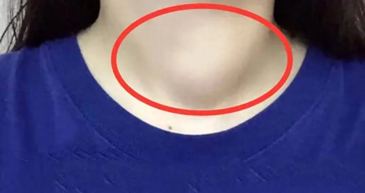 35 岁女子食疗 1 月，甲状腺结节从 1.2cm 增至 2.1cm...