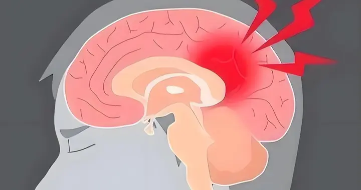 别等脑卒中来了才后悔，这5个信号出现，可能是在救你的命