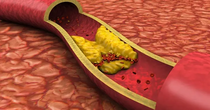 35岁的年龄，70岁的血管？这几个不良生活习惯加速血管“生锈”