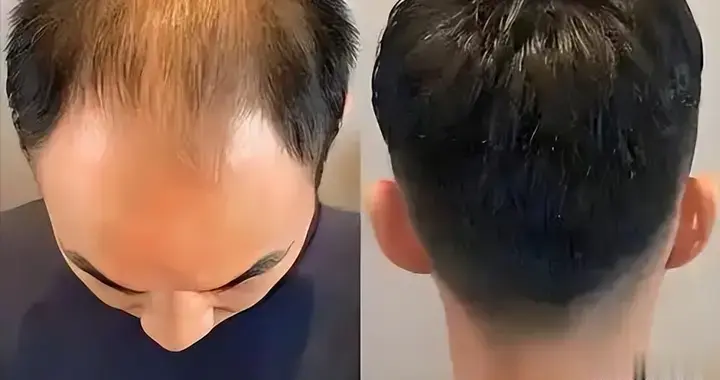 男人的福音：逆转脱发终于被破解了