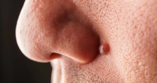 鼻子是肺的“镜子”，有这3种症状，就需要警惕肺结节，小心恶变