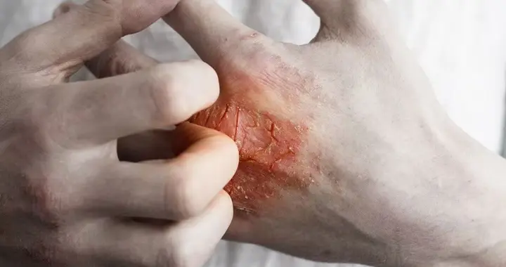 人不会无缘无故患上湿疹？容易患湿疹的人，背后或有这几个原因！