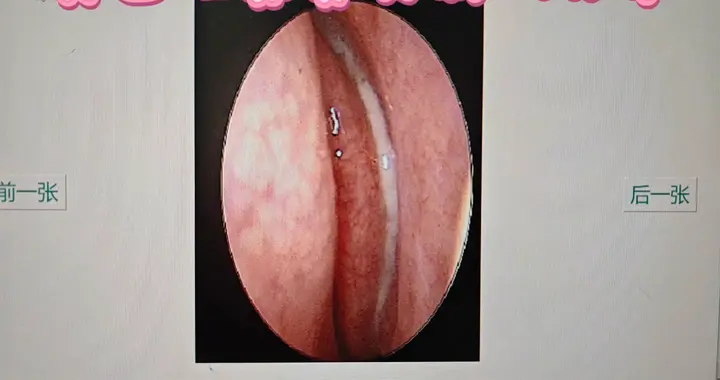 分享真实病例，揭秘真菌性鼻炎！