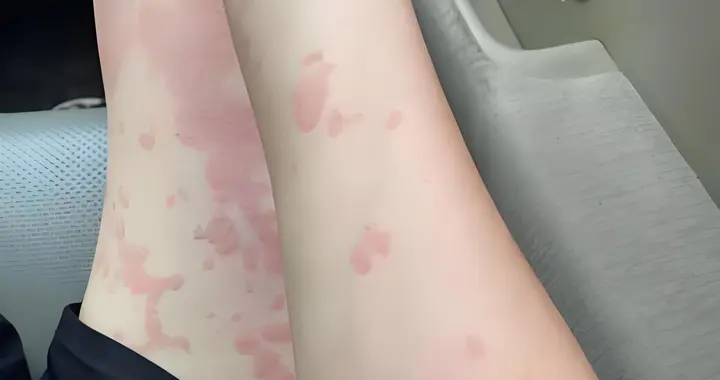 慢性荨麻疹千万别盲目找“去根”神药！别去根不成反倒伤了肝肾