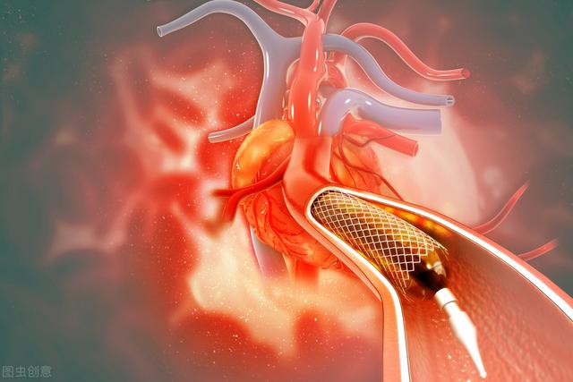 心肌梗塞|急性心肌梗死冠脉放了支架，还有哪些治疗是要坚持的？