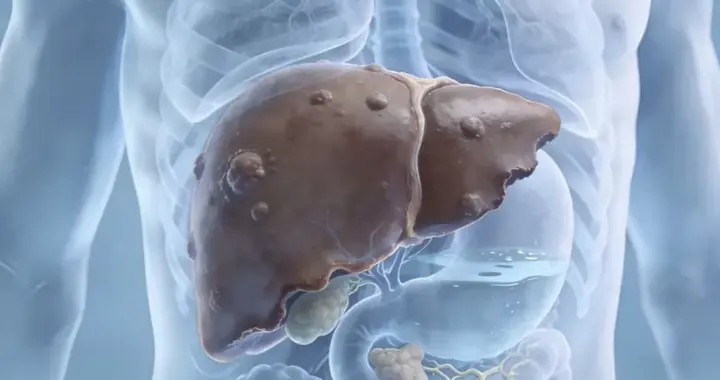 肝癌晚期，无法手术、不能化疗，稳住肿瘤还有第三条路