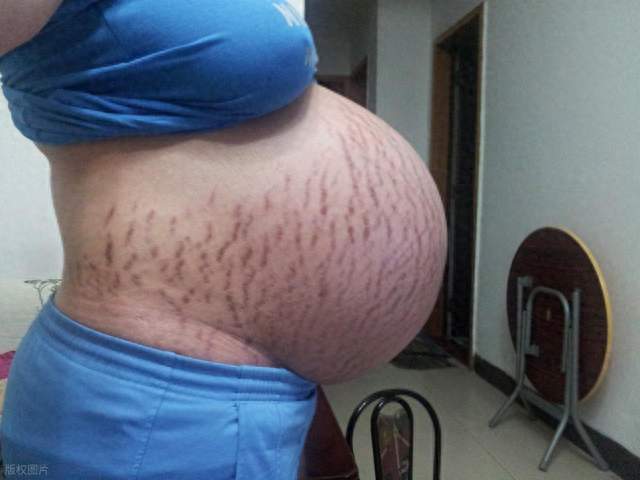 妊娠纹能预防？孕中期护理 3 招，减少纹路更自信！