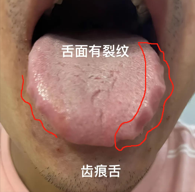 舌两边的齿痕，可不光是脾虚！常见的3种，看看你是哪一种？