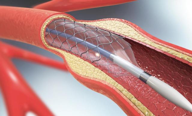 “心脏支架”被淘汰了吗？