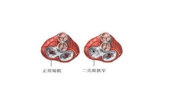 继续上一篇文章，如果心脏的“门”开关不好会怎么样？