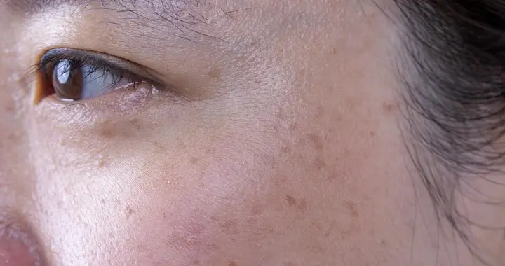 淡化雀斑别瞎试！防晒是关键，这些方法真的有用