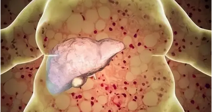 脂肪肝、血脂异常？菌群移植或带来治疗新希望！