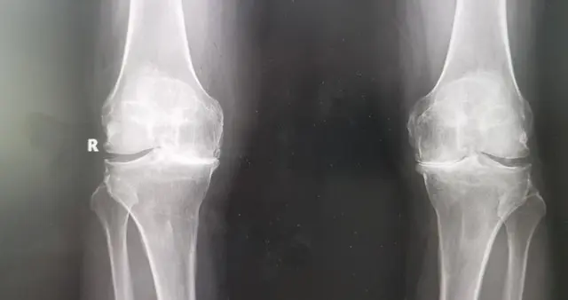 重度骨性关节炎，保守治疗药物推荐