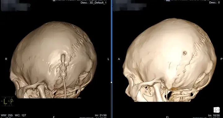 肖庆教授团队软性神经内镜技术成功拔除31年分流管的经典案例