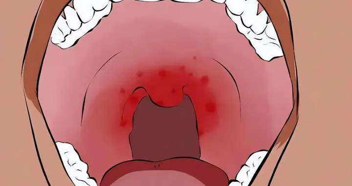 口腔溃疡反复发作？别再信上火了，及时就医，6个习惯容易患病