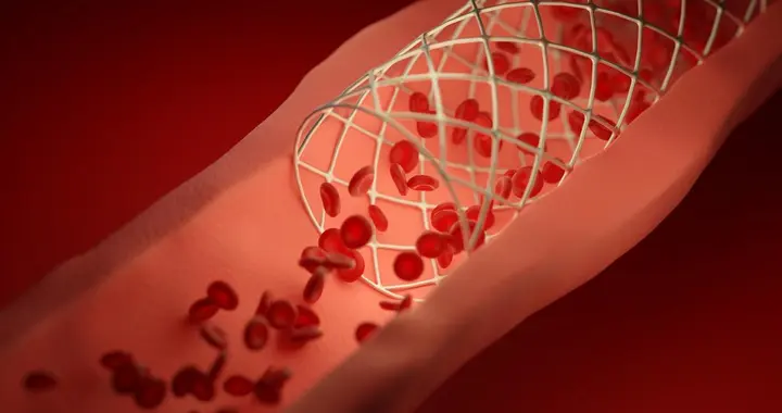 提醒：装了心脏支架，冠心病就再也不会复发了么？错！大错特错！