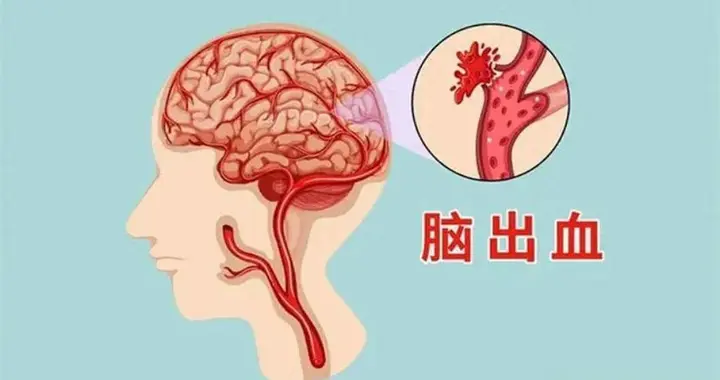 越来越多的人脑出血去世！医生含泪苦劝：这些事，再发也要戒掉