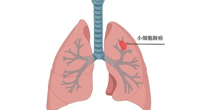 小细胞肺癌能手术的概率极低？只能放化疗了吗？听听郭医生怎么说