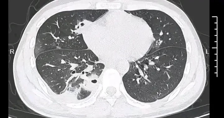 小伙挤颗痘进ICU！肺遭啃出10个洞，医生：你脸这“禁区”碰不得