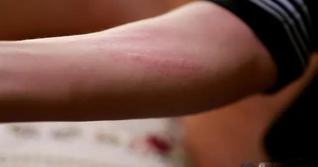 慢性荨麻疹别硬扛！3种中成药对症调，缓解瘙痒防复发，一文讲透